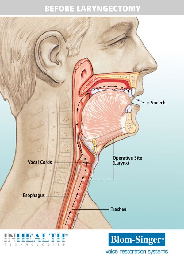 Anatomy before a laryngectomy versus after