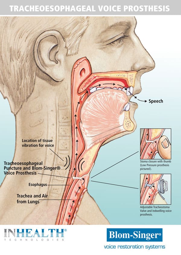 Tracheoesophageal voice prosthesis