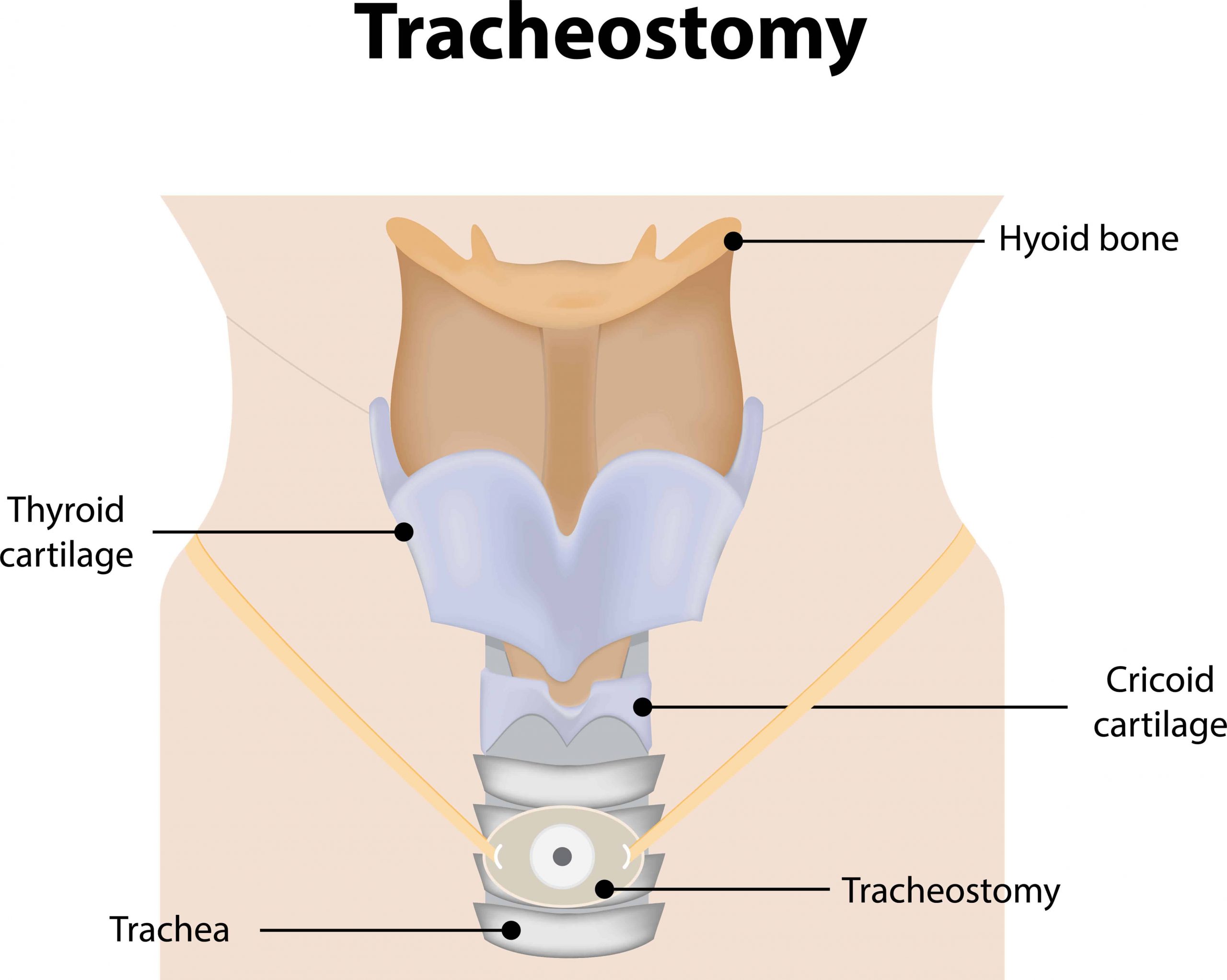 What Is Tracheostomy? Basics Of Breathing, Indications, Procedures And  Benefits | Tracheostomy Education