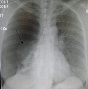 right sided pneumothorax image
