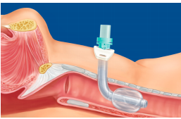 Shiley XLT proximal tracheostomy tube