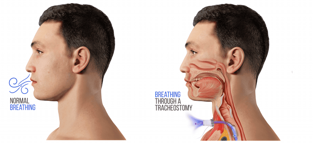 breathing with trach
